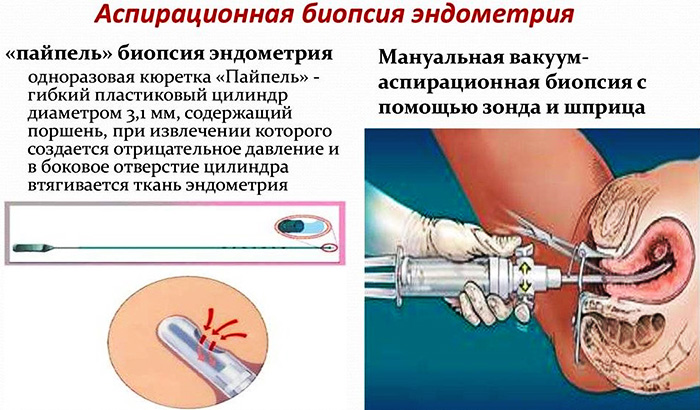 Пайпель-биопсия эндометрия. Что это такое, расшифровка результатов, цена