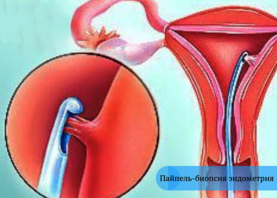 Пайпель-биопсия эндометрия. Что это такое, расшифровка результатов, цена
