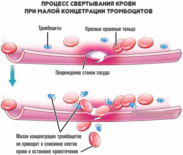 Ретракция кровяного сгустка. Что это такое, как определяется, функция, норма у детей