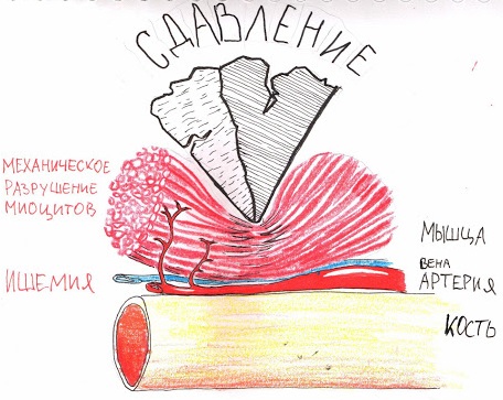 Синдром длительного сдавливания картинки