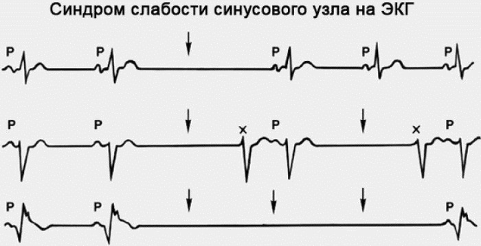 Синусовый ритм. Норма у женщин по возрасту на ЭКГ