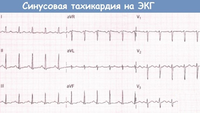 Синусовый ритм. Норма у женщин по возрасту на ЭКГ