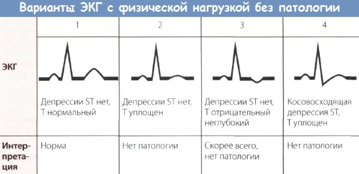 Синусовый ритм. Норма у женщин по возрасту на ЭКГ