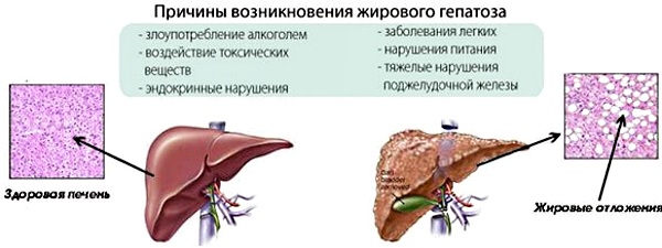 Стеатогепатоз печени. Лечение и диета у женщин, мужчин