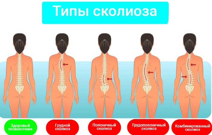 Боковое искривление позвоночника. Что это, как называется, упражнения, лечение