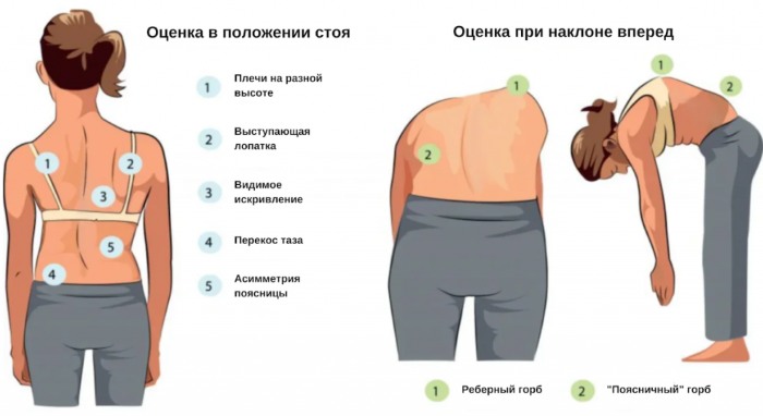 Боковое искривление позвоночника. Что это, как называется, упражнения, лечение