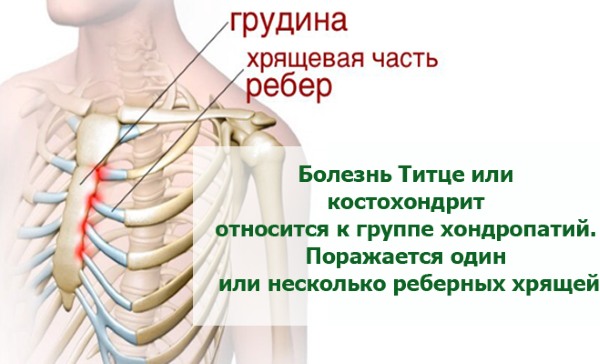 Боль между ребрами посередине спереди, при нажатии, если тяжело дышать