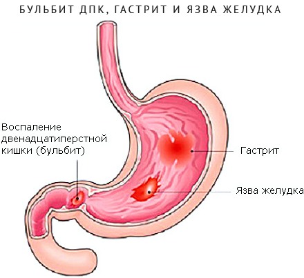 Бульбит. Симптомы и лечение у взрослых, что это такое