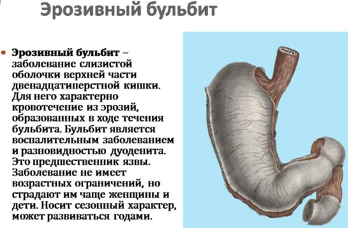 Бульбит. Симптомы и лечение у взрослых, что это такое