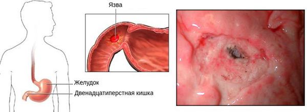 Бульбит. Симптомы и лечение у взрослых, что это такое