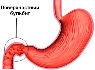 Бульбит. Симптомы и лечение у взрослых, что это такое