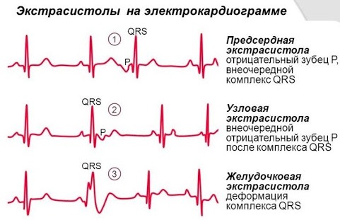 Экстрасистолия сердца. Причины, симптомы, лечение у взрослых, детей