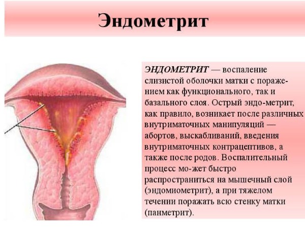 Хронический эндометрит. Что это такое, симптомы и лечение