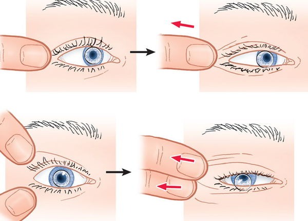 Как достать линзу из глаза, если ушла под веко, прилипла