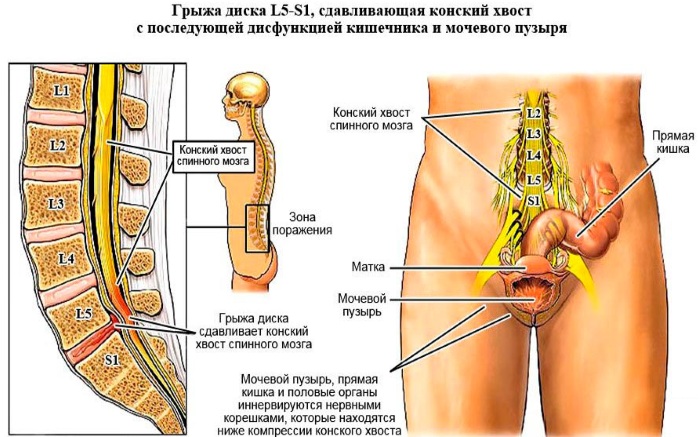 L5-S1 грыжа. Где находится у человека, фото, схема позвоночника