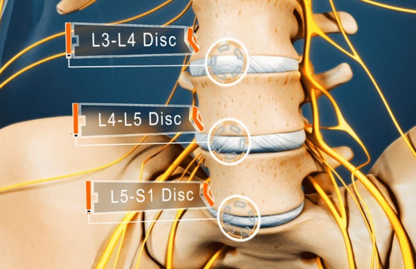 L5-S1 грыжа. Где находится у человека, фото, схема позвоночника