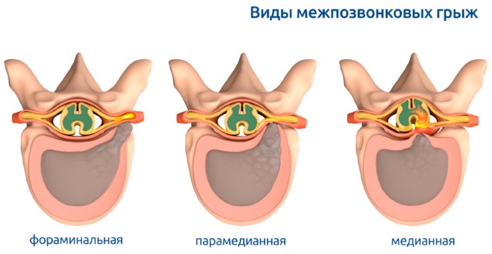 L5 S1 Где Находится У Человека Фото