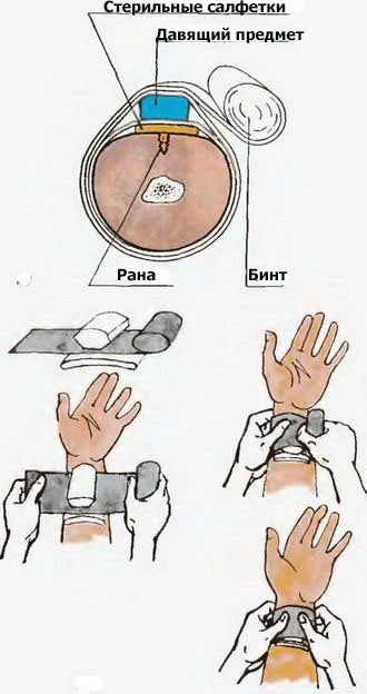 Наложение давящей повязки. Алгоритм при венозном, артериальном кровотечении
