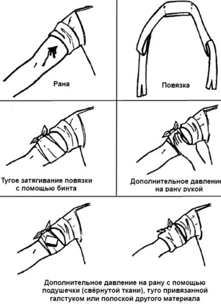 Наложение давящей повязки. Алгоритм при венозном, артериальном кровотечении