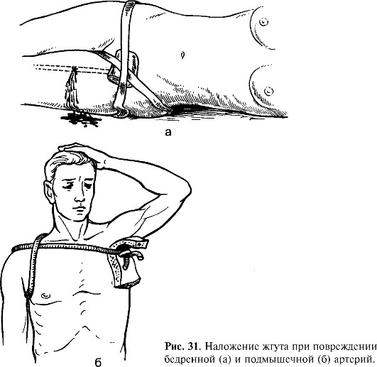 Наложение давящей повязки. Алгоритм при венозном, артериальном кровотечении