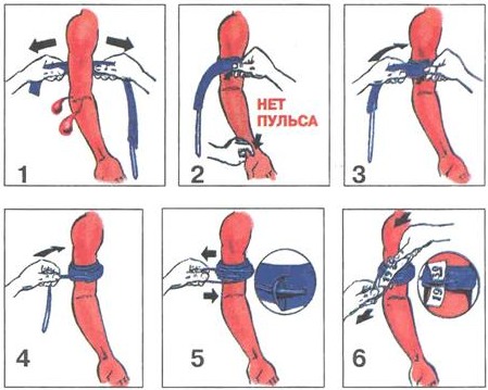 Наложение давящей повязки. Алгоритм при венозном, артериальном кровотечении