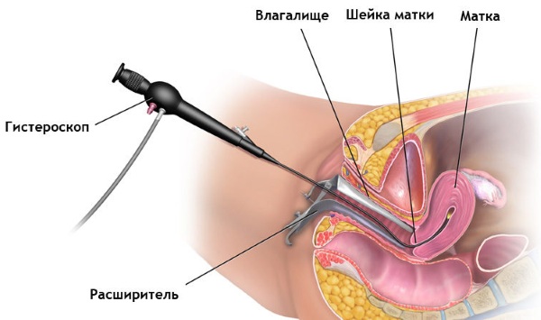 Офисная гистероскопия. Что это такое в гинекологии, больно ли удаление полипа