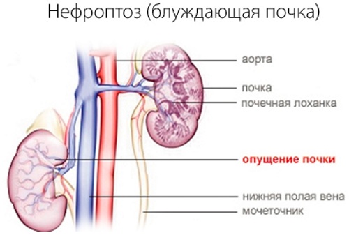 Опущение почки у женщин. Симптомы и лечение, причины