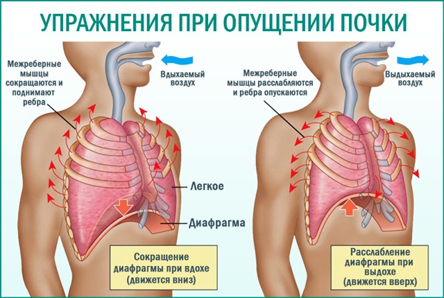 Опущение почки у женщин. Симптомы и лечение, причины