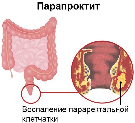 Парапроктит. Классификация по локализации, клиника, лечение