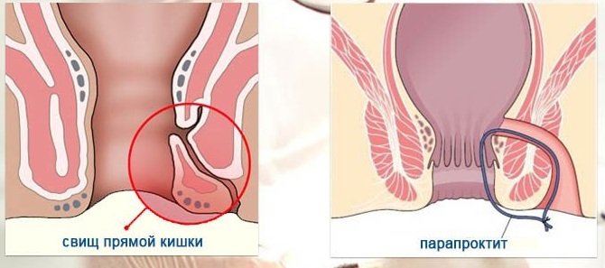 Парапроктит. Классификация по локализации, клиника, лечение