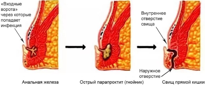 Парапроктит. Классификация по локализации, клиника, лечение