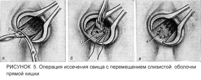 Парапроктит. Классификация по локализации, клиника, лечение