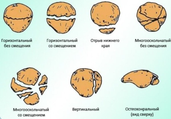 Перелом коленной чашечки без смещения. Лечение, сроки срастания