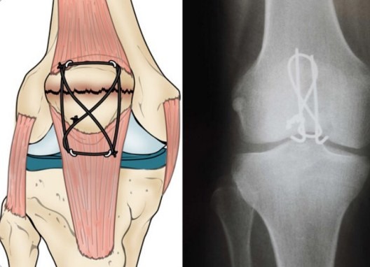 Перелом коленной чашечки без смещения. Лечение, сроки срастания