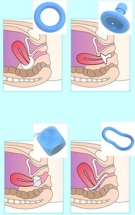 Пессарий гинекологический при опущении матки. Где купить, виды, отзывы