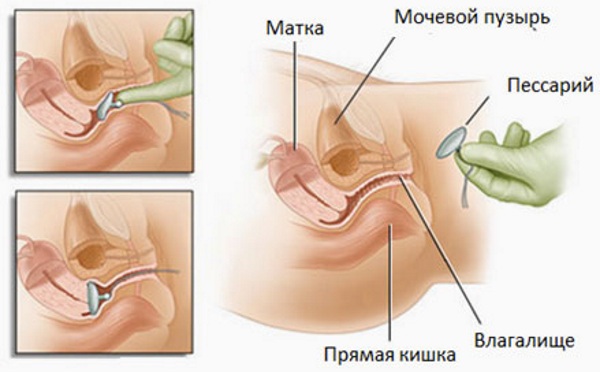 Пессарий гинекологический при опущении матки. Где купить, виды, отзывы