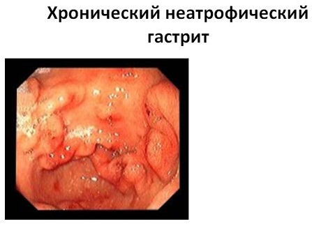 Поверхностный гастрит: диета, меню на каждый день