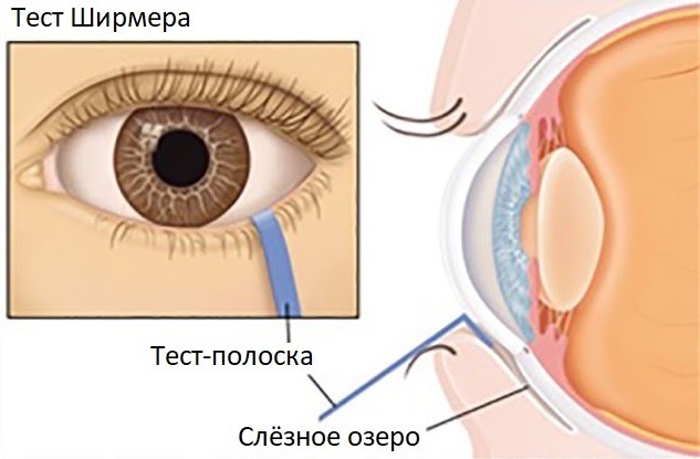 Проба Ширмера в офтальмологии. Что это такое, как проводить, норма