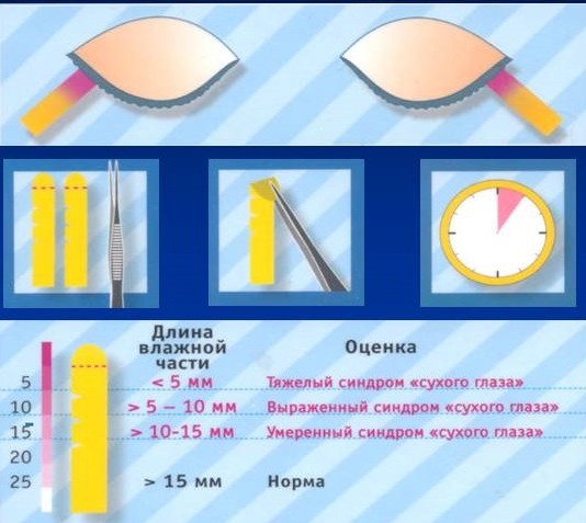 Проба Ширмера в офтальмологии. Что это такое, как проводить, норма