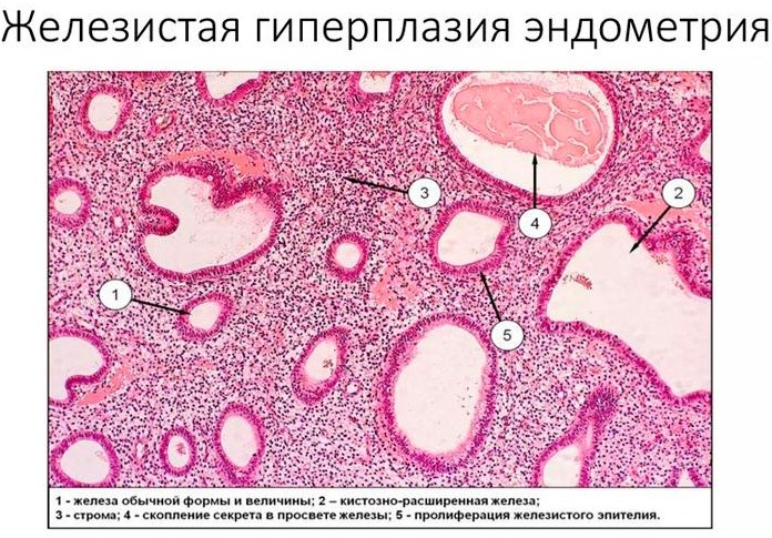 Пролиферативная фаза менструационного цикла. Что это, толщина эндометрия