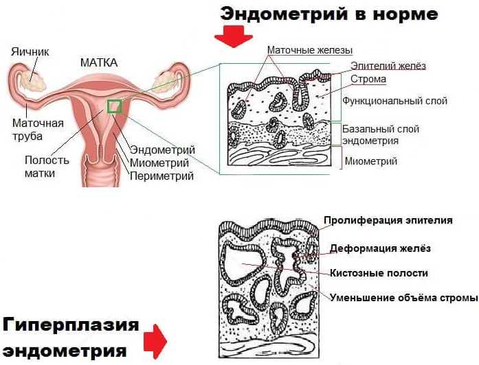 Толщина эндометрия на фоне тамоксифена