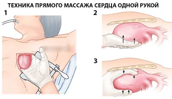 Прямой массаж сердца. Что это такое, когда применяют, техника выполнения