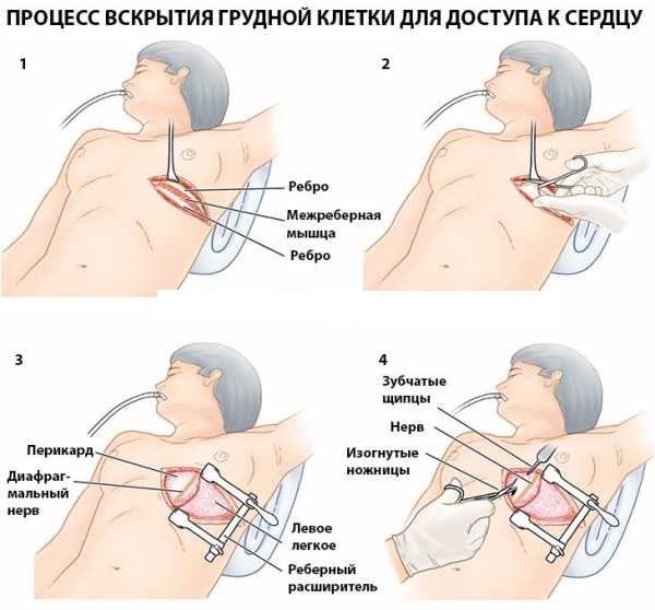 Прямой массаж сердца. Что это такое, когда применяют, техника выполнения