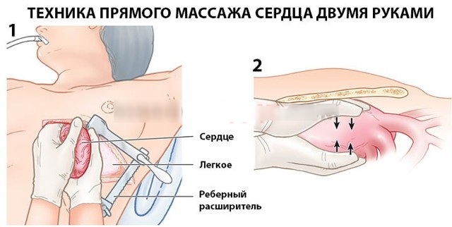 Прямой массаж сердца. Что это такое, когда применяют, техника выполнения