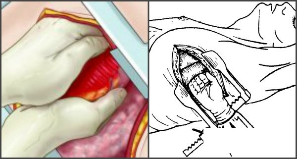 Прямой массаж сердца. Что это такое, когда применяют, техника выполнения