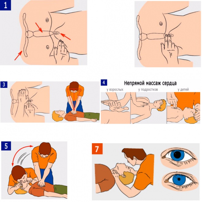 Прямой массаж сердца. Что это такое, когда применяют, техника выполнения