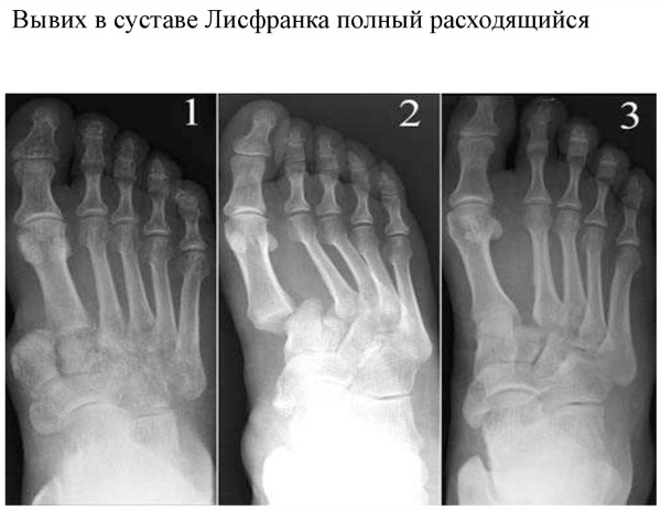Сустав Шопара и Лисфранка. Анатомия, рентген, связки, вывих стопы, остеоартроз