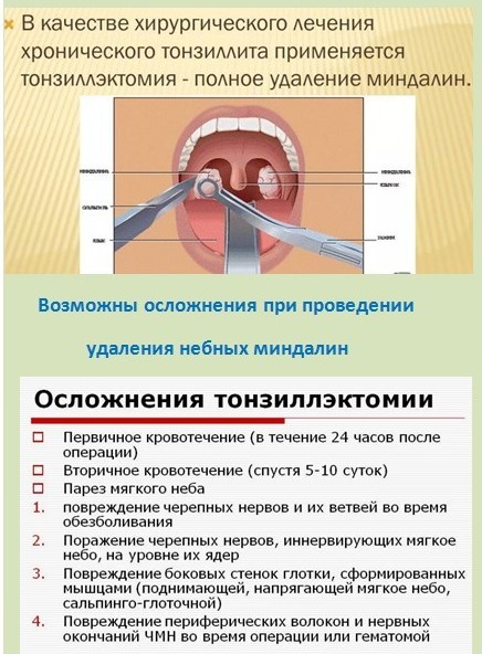 Удаление миндалин фото после операции