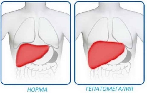 Умеренная гепатомегалия печени. Что это такое у взрослого, ребенка