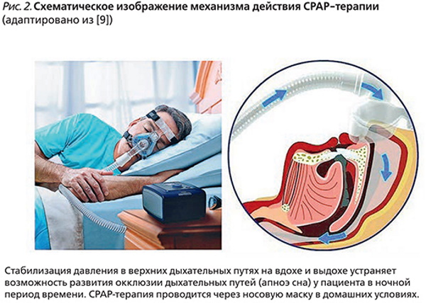 СИПАП (CPAP) терапия. Что это такое, кому показана, отзывы